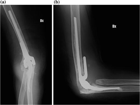 Elbow Replacement Xray